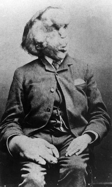 Illustration for article titled Did Joseph Merrick, known as "elephant man," have Proteus Syndrome?